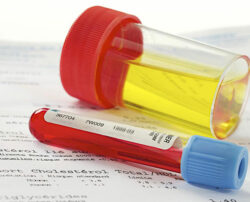 4 alarming reasons why blood appears in urine