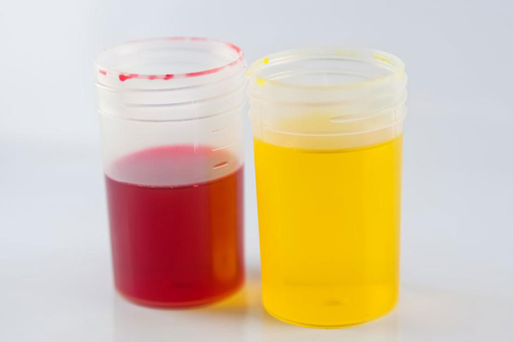 Definition, causes and symptoms of urine color