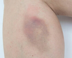 Easy bruising – Causes and treatments