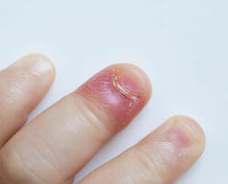 Four reasons for swollen finger pain