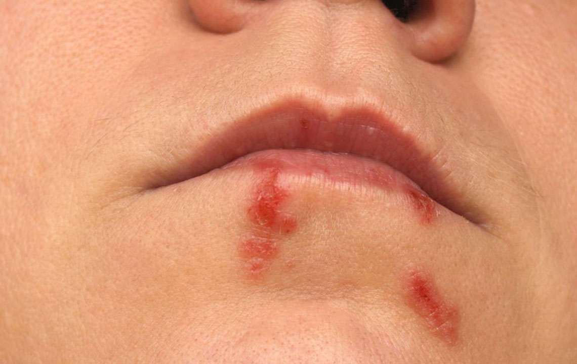 5 natural ways to deal with cold sore