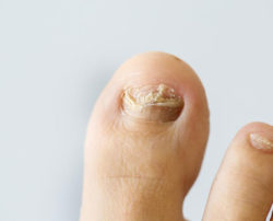 Common nail infections to avoid